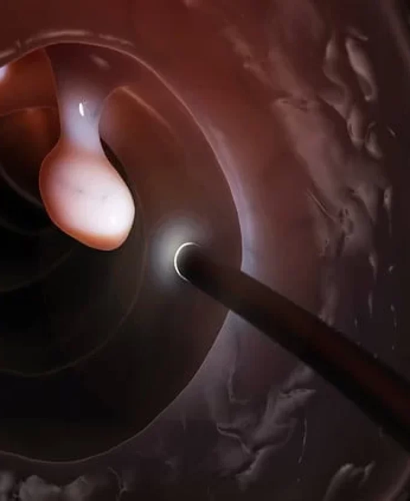 Colonoscopy-polyp-removal-1.jpg