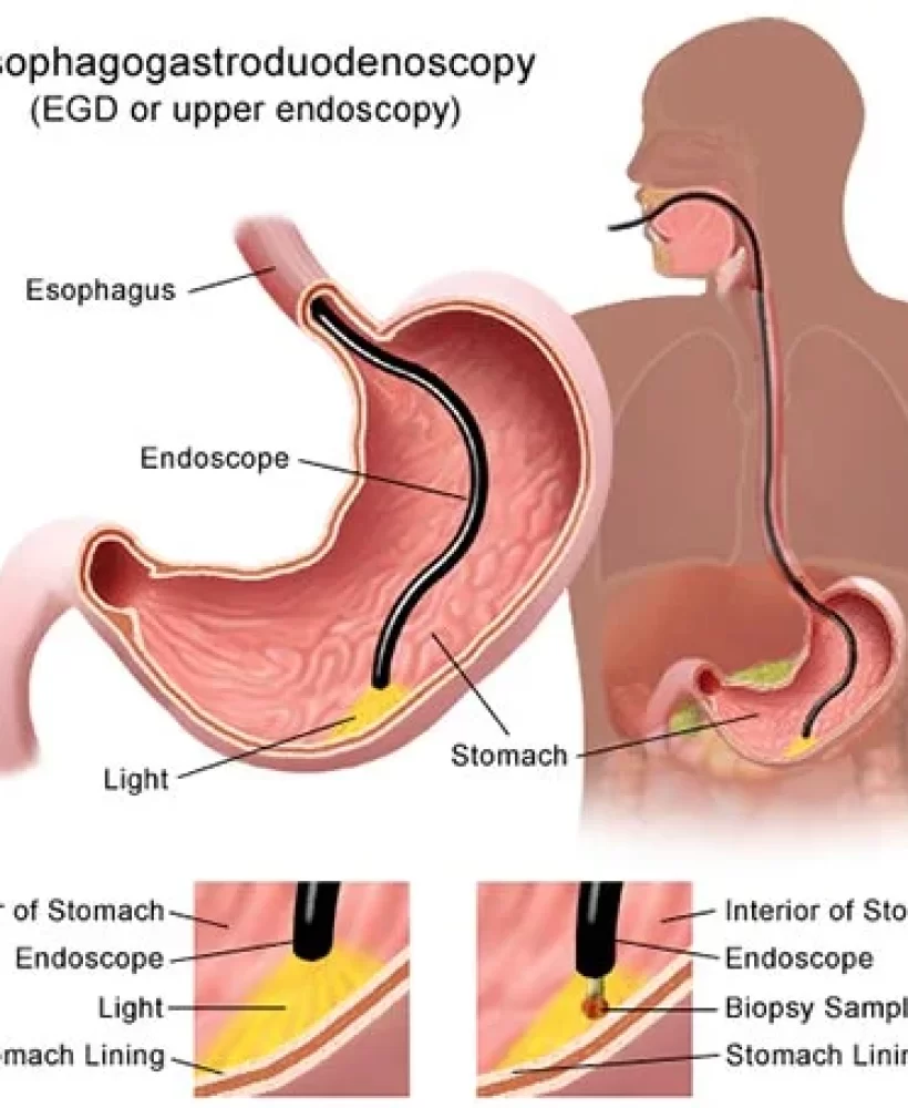 Upper-GI-Endoscopy1.jpg